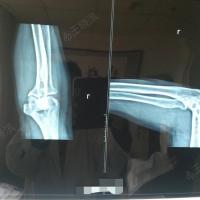 女56岁,挠骨远端折术后再骨折下尺桡关节分离