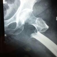 女62岁,股骨粗隆下骨折内固定术后钢板断裂
