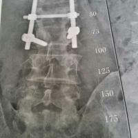 男50,第二腰椎爆裂性骨折