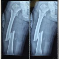 48岁女性肱骨近端爆裂性骨折,股骨多段粗隆间骨折