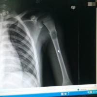 男7,左肱骨上段骨囊肿并病理性骨折