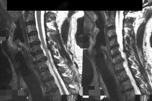 有度颈椎病视频之三--神经根型颈椎病视频