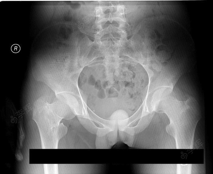 男37, 股骨颈基底部骨折