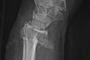 右手桡骨远端及尺骨茎突骨折