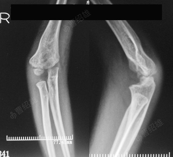 患儿,8岁,右肘关节内翻畸形并脱位