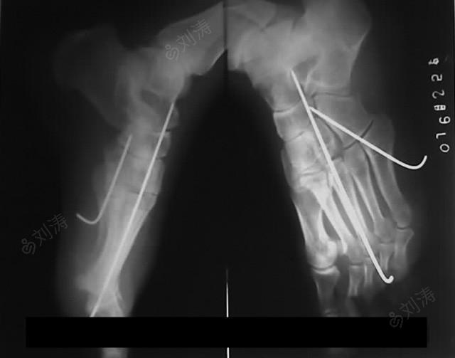 男性,41岁,左足ii-v跗跖关节骨折脱位