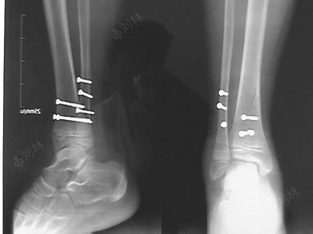男,13岁,儿童骨骺损伤.踝关节