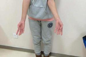 女,12岁,左肘外翻畸形