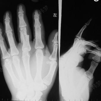 男,24岁,左手中指近端指节开放性骨折