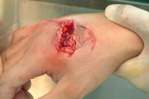 伤口近侧缘3*3cm皮肤血运差,掌侧有一长约3cm伤口,深达皮下,右手诸指