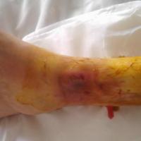 4个月前左小腿皮肤擦伤,一直未愈,来院就诊.
