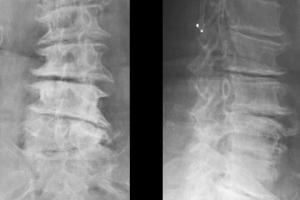 女,69岁,腰椎退行性脊柱侧弯椎管狭窄
