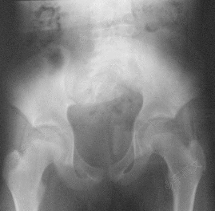 男,14岁,臀部隆起