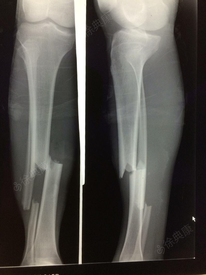 辅助检查 血沉及crp正常 诊断 左胫腓骨骨折术后不愈合 术后4月,折端