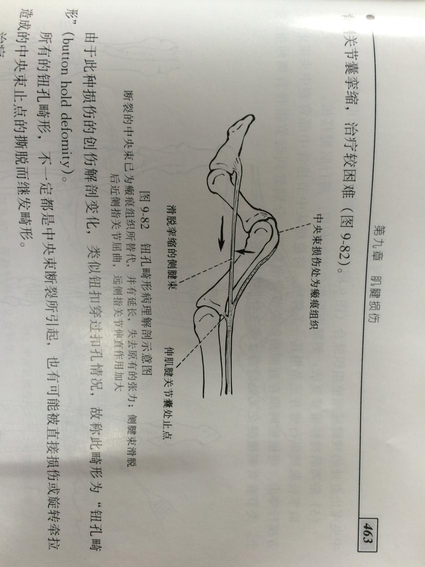 【概述】 伸指肌腱中央腱束损伤,早期依靠侧腱束的作用,仍可伸直近侧