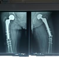 股骨头置换术后一年,同侧股骨干骨折