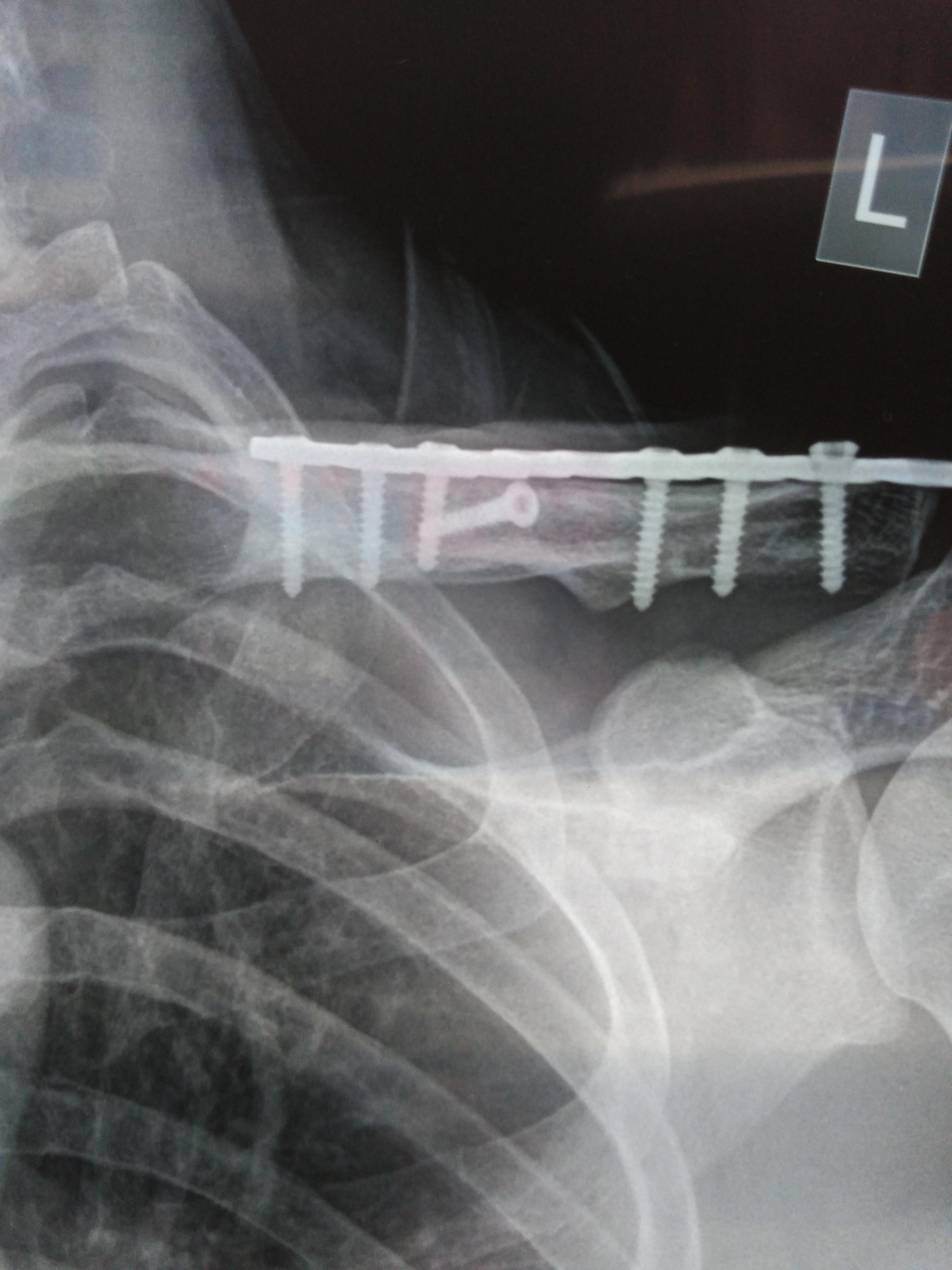 本人做的一例锁骨骨折内固定术后三年采用该方法取出.
