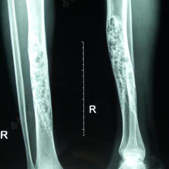 右胫骨骨纤维样异常增生症
