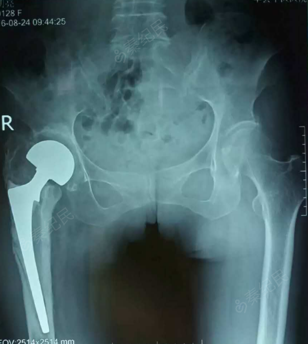 右侧股骨头置换术后8年股骨假体松动下沉,该如何治疗?