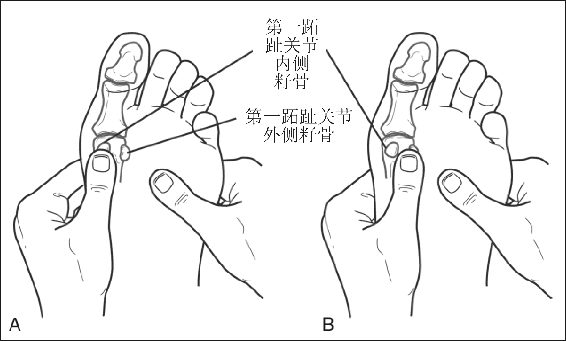 图示第一跖趾关节籽骨的触诊方法