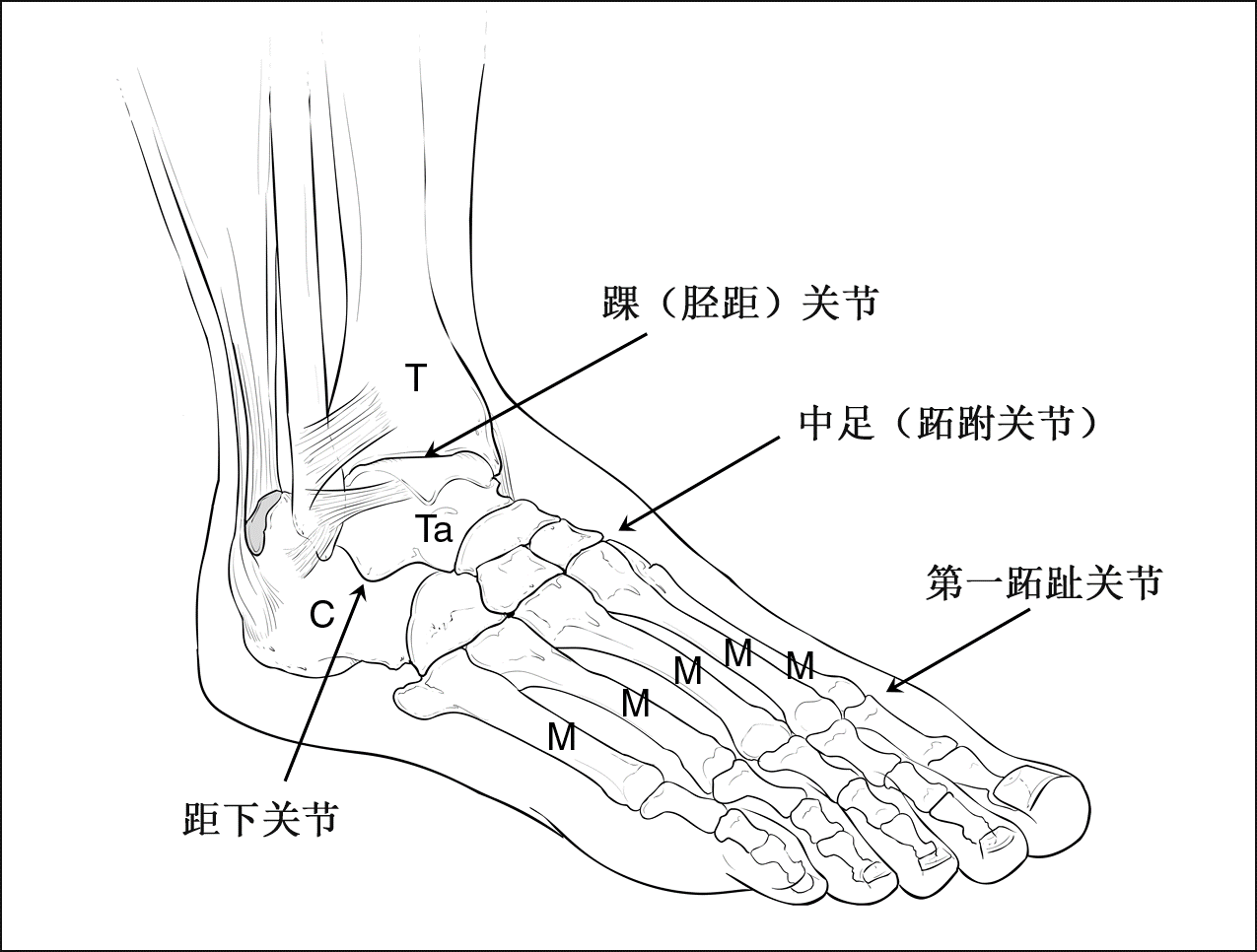 位于第一跖趾关节(拇趾跖趾关节)(拇僵硬),中足(跖跗关节),距舟关节