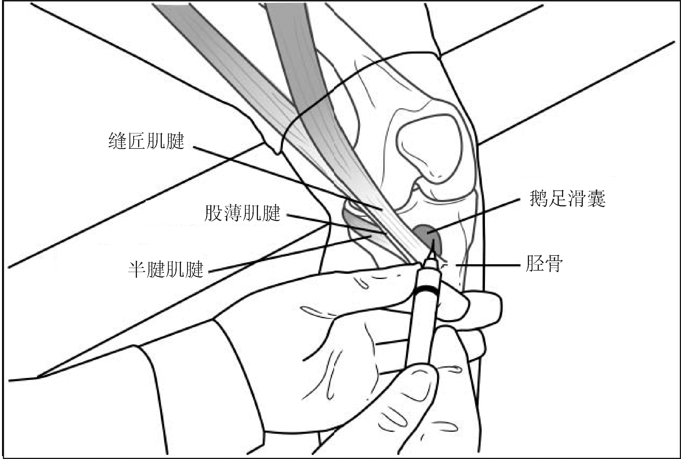 操作:鹅足滑囊注射术