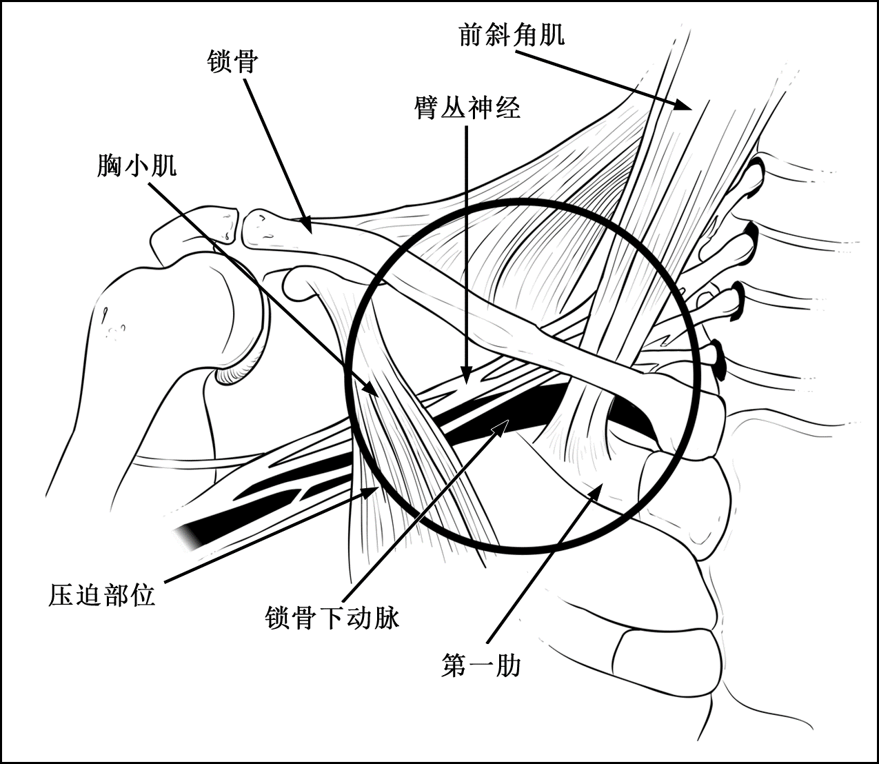 胸廓出口综合征