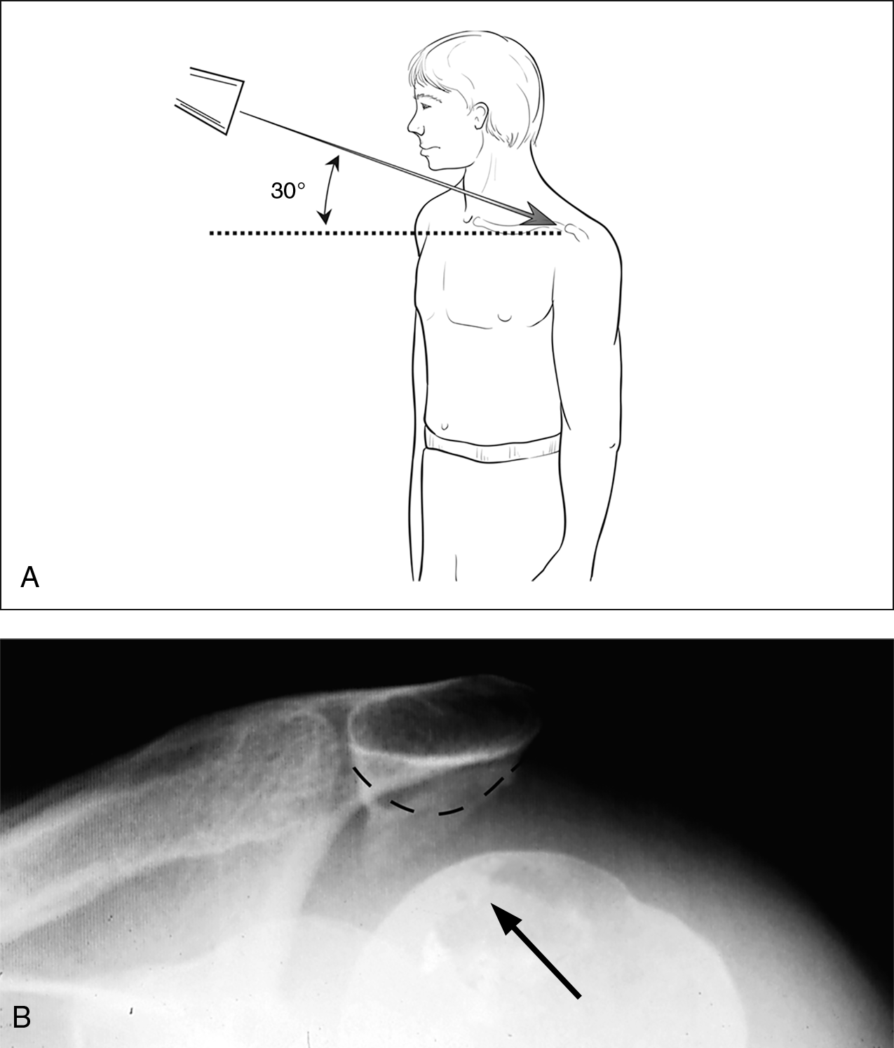 可显示肩峰呈钩状,骨赘位于肩峰前侧(图4,但肩峰有骨赘未必肩袖就有