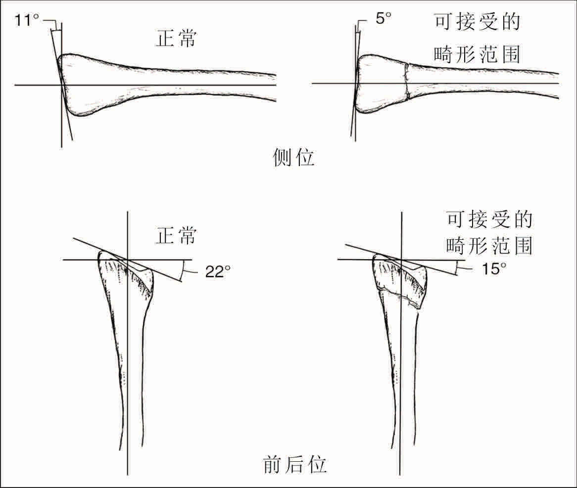 桡骨远端骨折