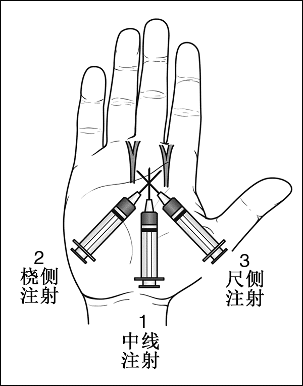 操作手指局部阻滞麻醉术