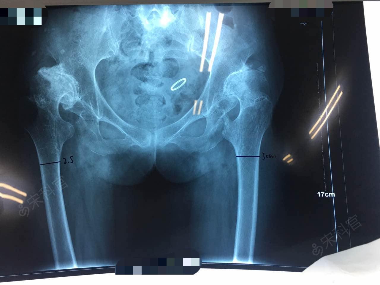 双髋关节置换术后
