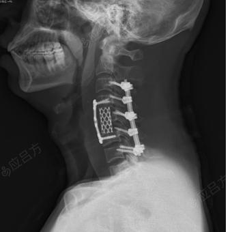 颈椎前纵韧带钙化图片