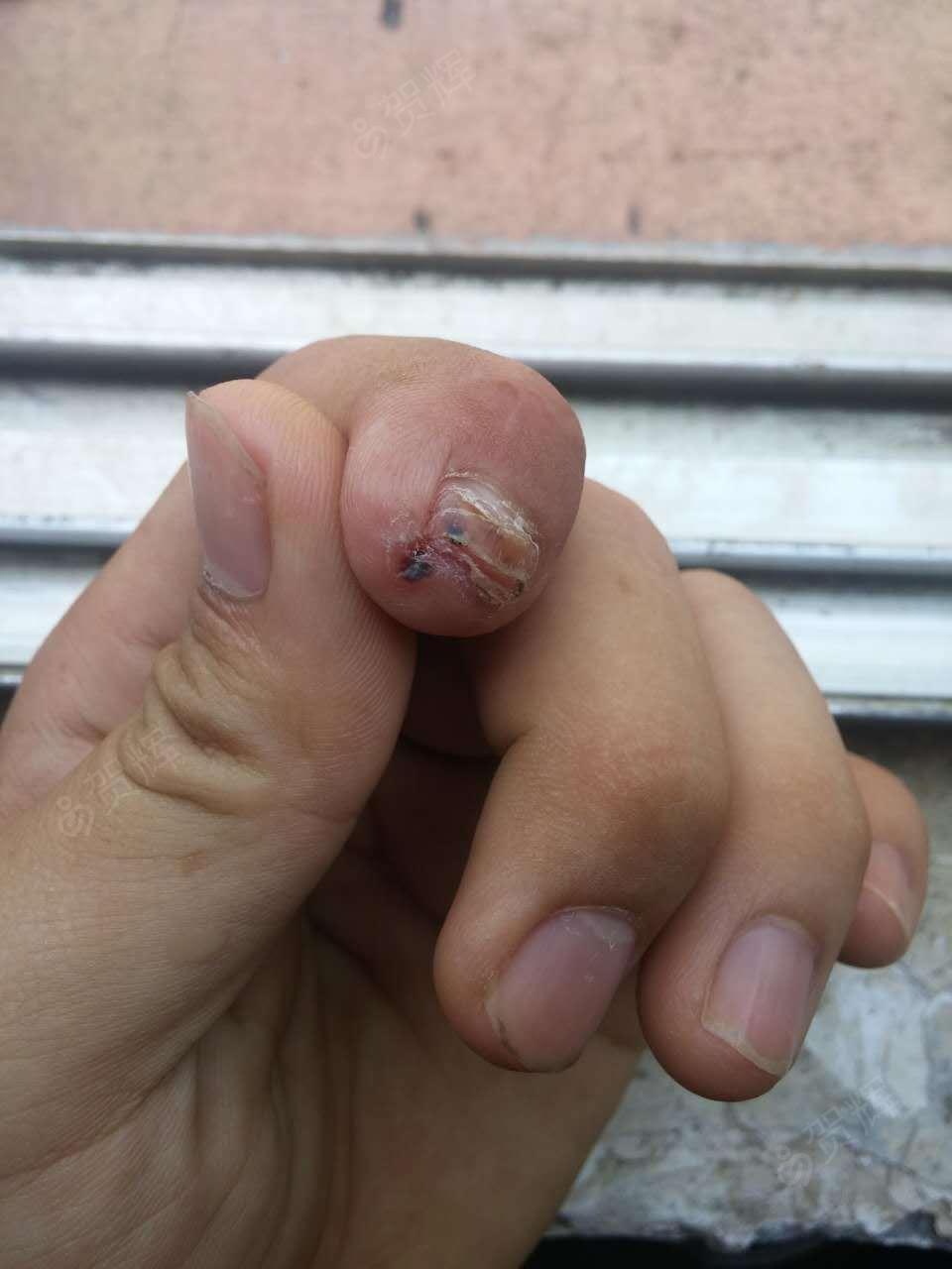 左食指末节缺损