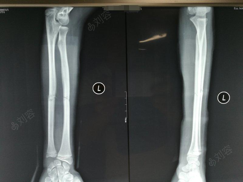 手法复位治疗双尺桡骨骨折
