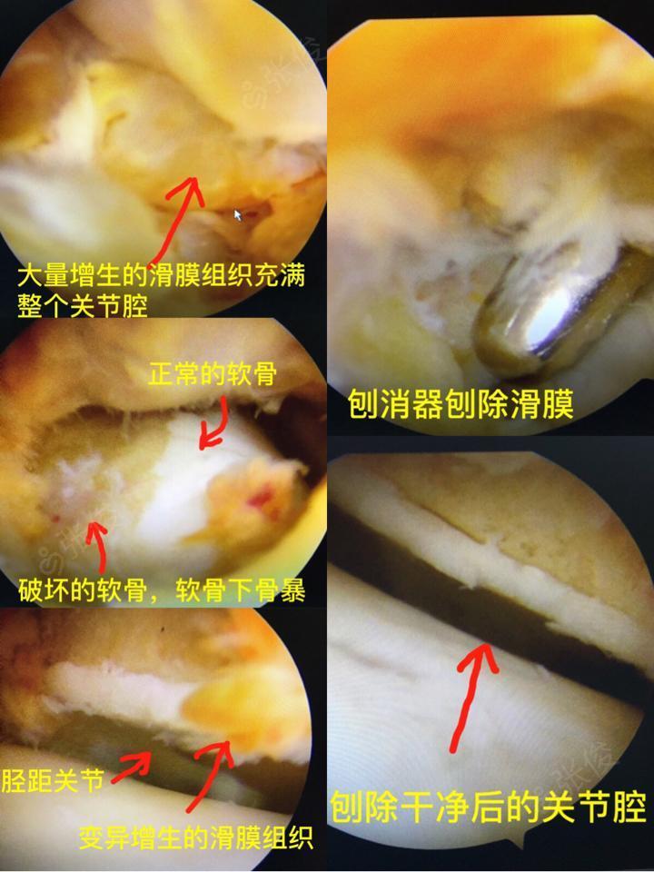 辅助检查 左踝核磁示左踝关节内滑膜增生,考虑滑膜病变,色素沉着绒毛