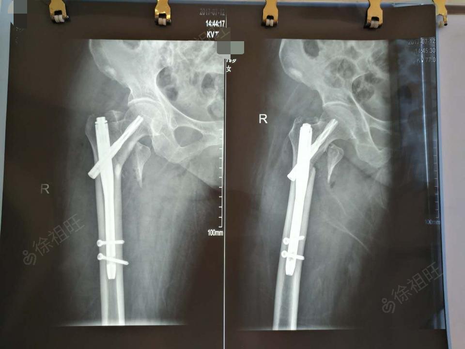 诊断 右股骨粗隆间骨折 治疗过程 是否手术?