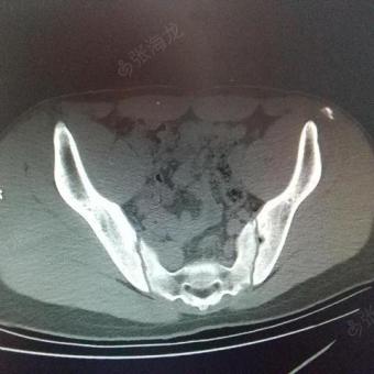 左髂前上棘骨折