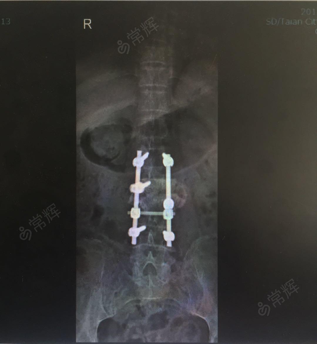 腰椎退行性变 腰椎间盘突出