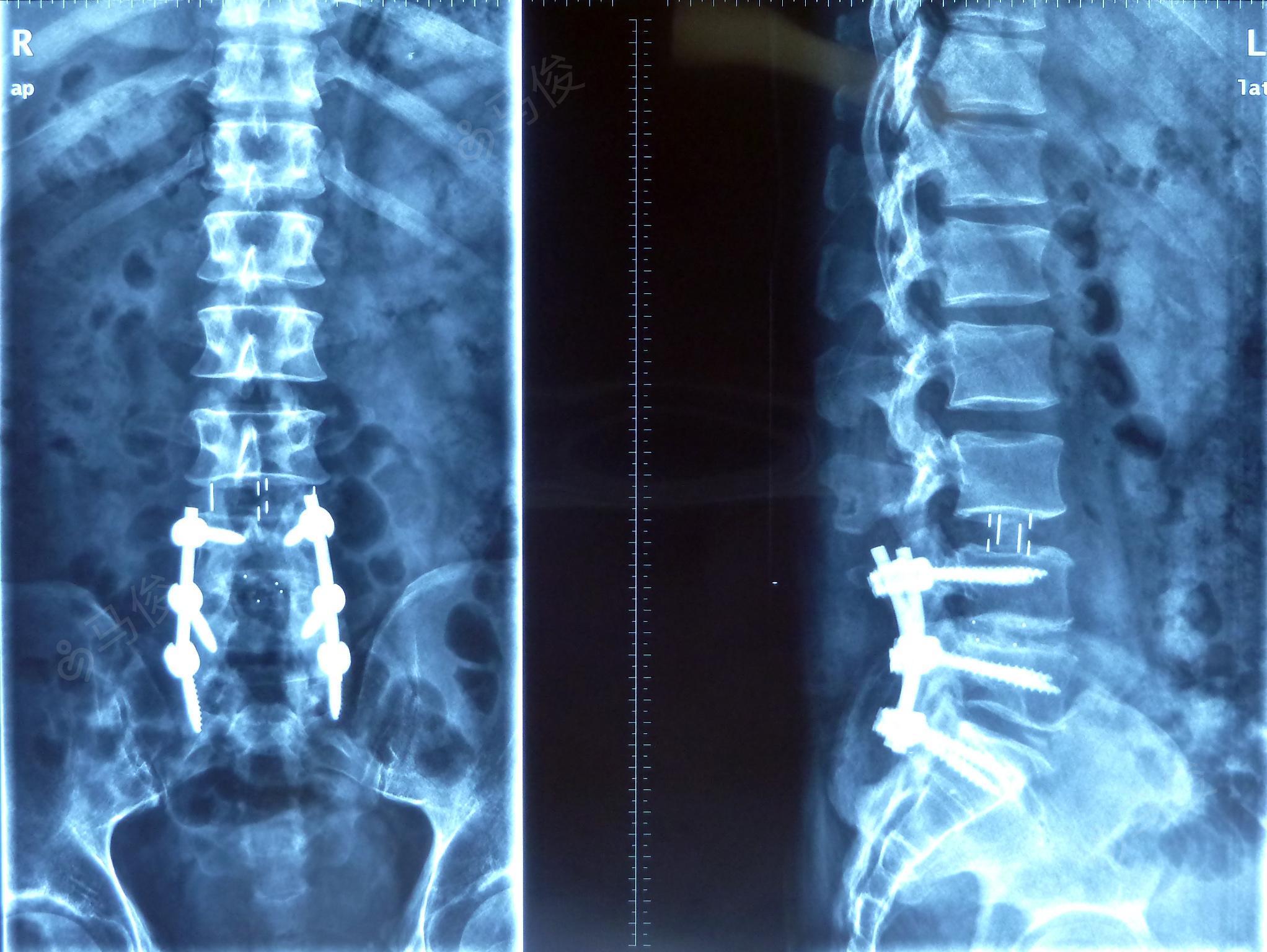 olif治疗腰椎融合术后邻近节段退变