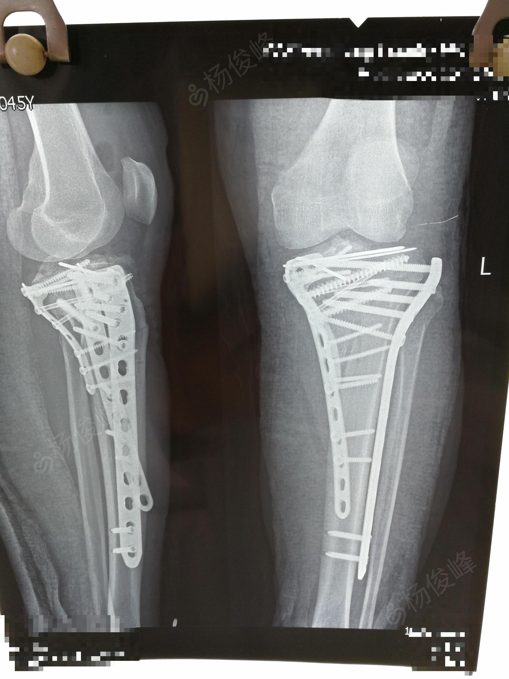 胫骨平台粉碎性骨折并膝关节脱位(左)