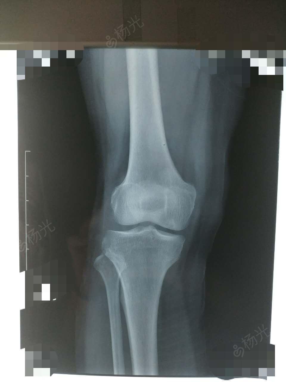 右膝半月板损伤