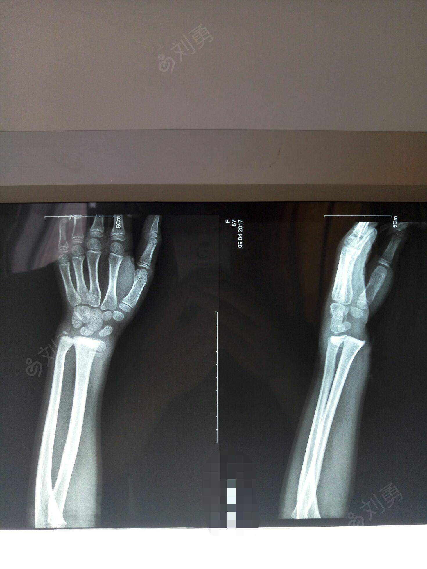 吐等不适,由家人送本院就诊,查x线片提示左尺桡骨远端骨折并骨骺损伤