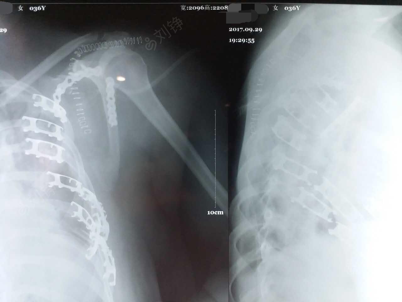 肩胛骨骨折(左,millerⅣ型)切开复位内固定