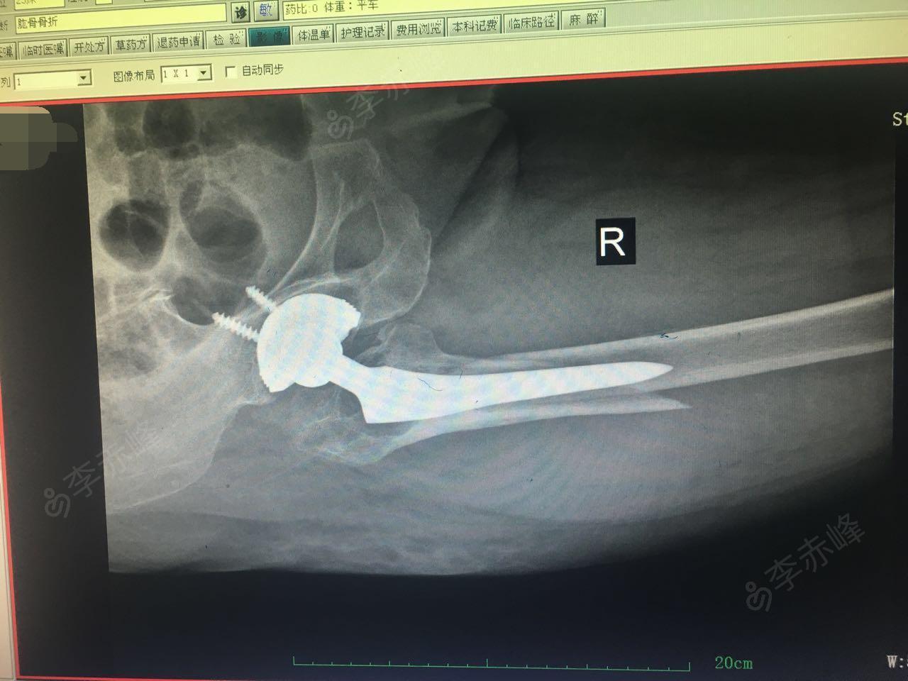 右股骨骨折,右髋骨置换术后