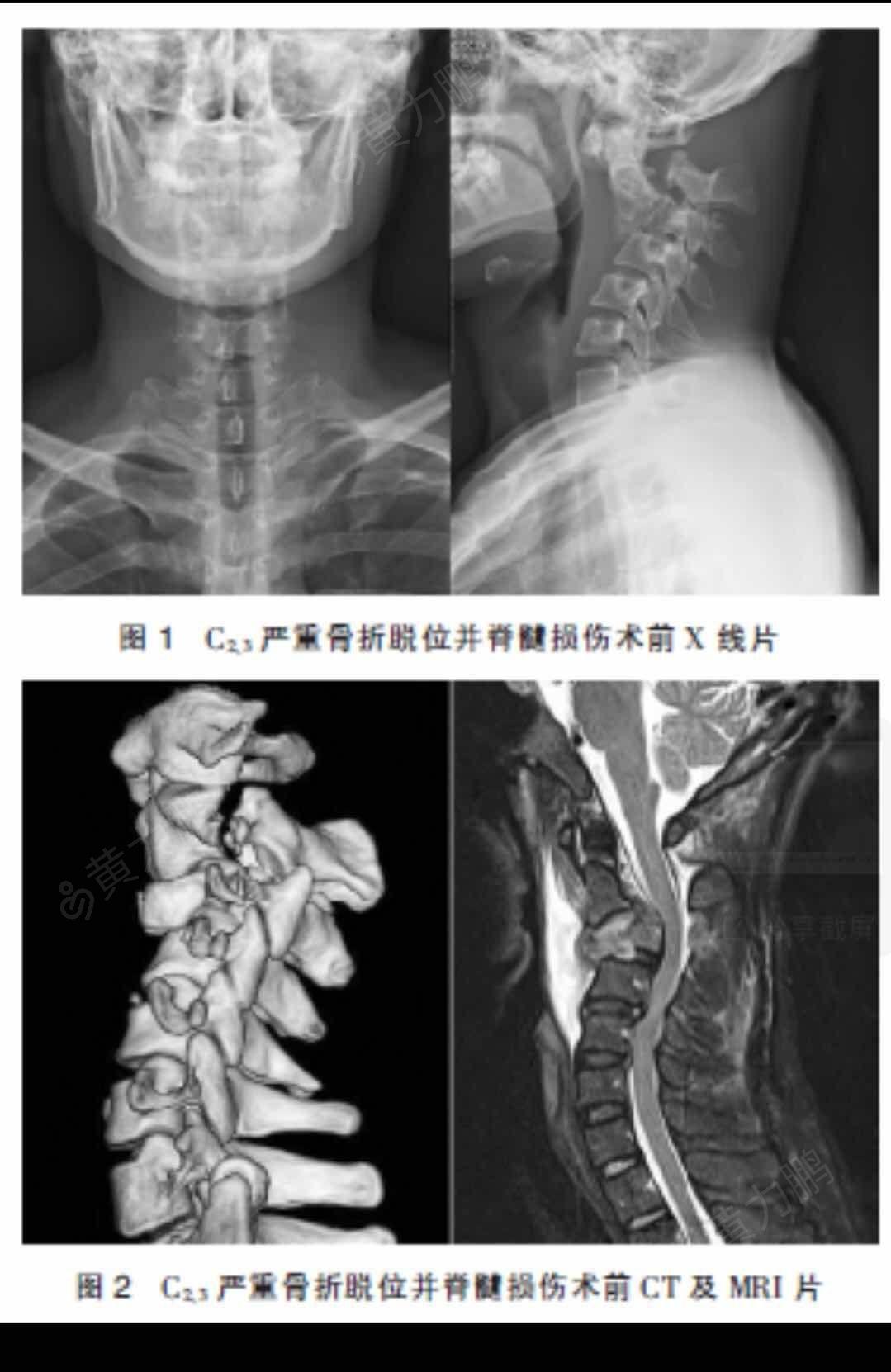 严重颈椎骨折脱位并颈髓损伤