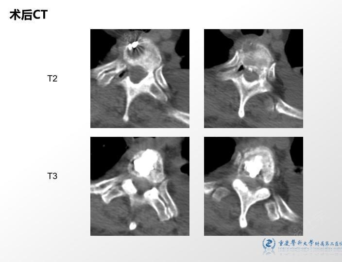 手术记录 1,经皮穿刺t3椎体成形 经皮穿刺t2,t3放射性粒子植入 经皮