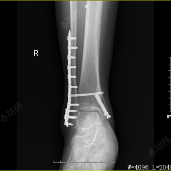 右侧内踝,胫骨前缘及右腓骨下段骨折