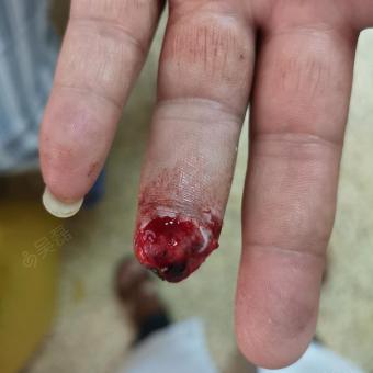 皮耐克修复手指末端软组织缺损