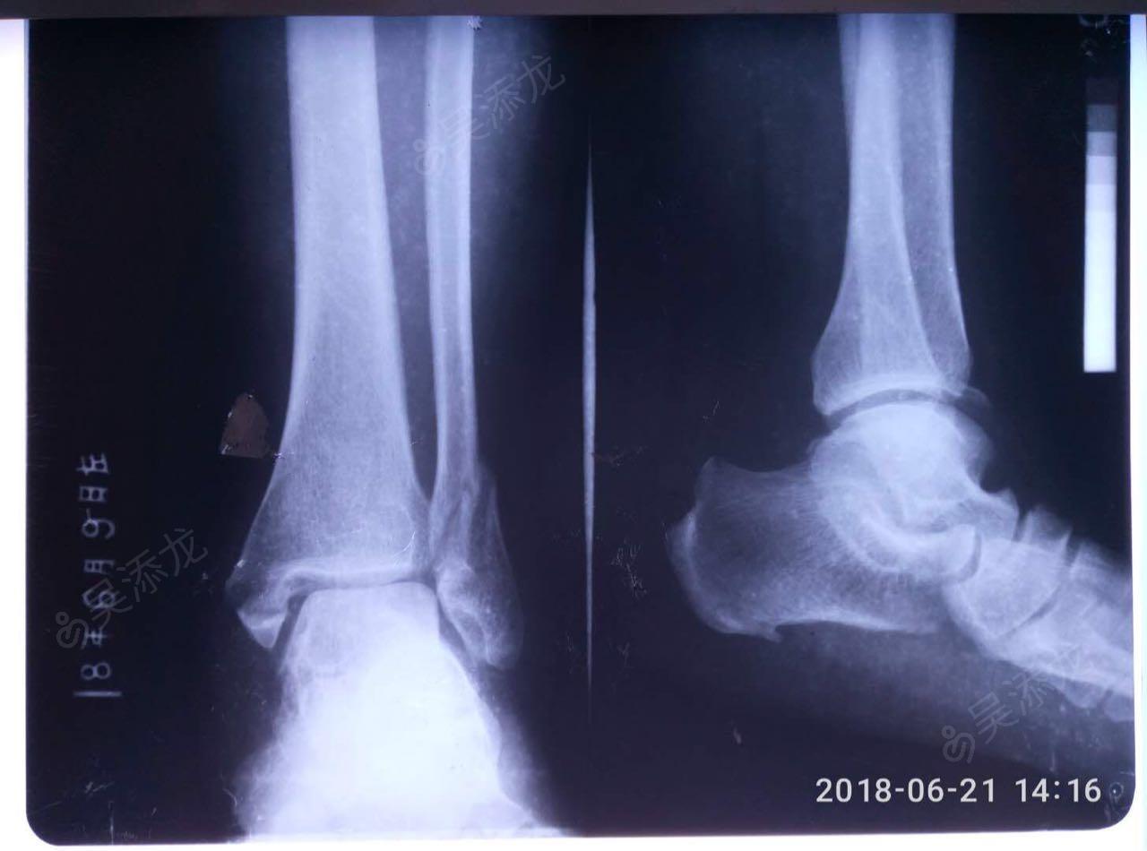 【物理治疗师视角】青少年运动性足踝痛：副舟骨综合征！ - 知乎