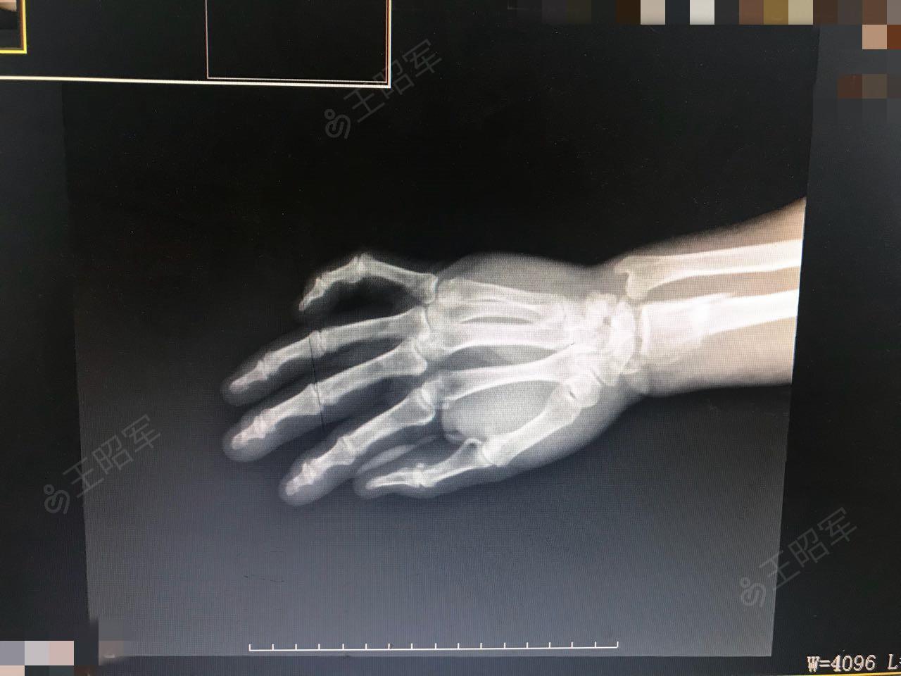 右桡骨远端粉碎性骨折